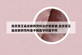 南京蔣王廟皮膚研究所治療銀屑病 南京蔣王廟皮膚研究所是中國(guó)醫(yī)學(xué)科醫(yī)學(xué)院