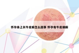 懷孕身上長牛皮癬怎么回事 懷孕有牛皮病癬