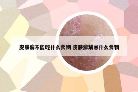 皮膚癬不能吃什么食物 皮膚癬禁忌什么食物
