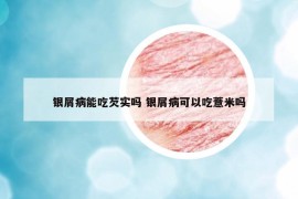 銀屑病能吃芡實(shí)嗎 銀屑病可以吃薏米嗎