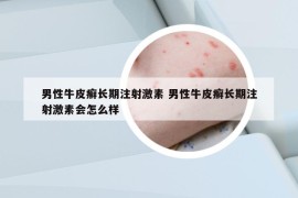 男性牛皮癬長期注射激素 男性牛皮癬長期注射激素會(huì)怎么樣