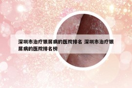 深圳市治療銀屑病的醫(yī)院排名 深圳市治療銀屑病的醫(yī)院排名榜