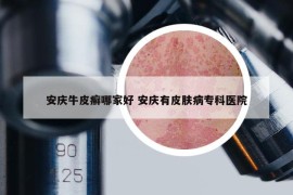 安慶牛皮癬哪家好 安慶有皮膚病?？漆t(yī)院