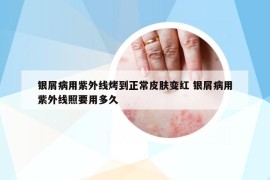 銀屑病用紫外線烤到正常皮膚變紅 銀屑病用紫外線照要用多久