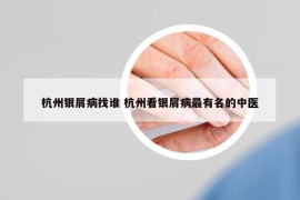 杭州銀屑病找誰 杭州看銀屑病最有名的中醫(yī)