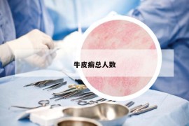牛皮癬總?cè)藬?shù)