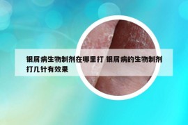 銀屑病生物制劑在哪里打 銀屑病的生物制劑打幾針有效果