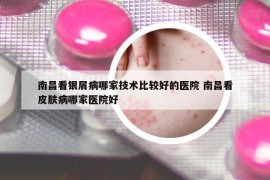 南昌看銀屑病哪家技術(shù)比較好的醫(yī)院 南昌看皮膚病哪家醫(yī)院好