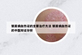 銀屑病血熱證的主要治療方法 銀屑病血熱證的中醫(yī)辯證分析