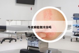 牛皮癬能做冷凍嗎