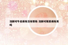 泡腳對(duì)牛皮癬有沒有幫助 泡腳對(duì)銀屑病有用嗎