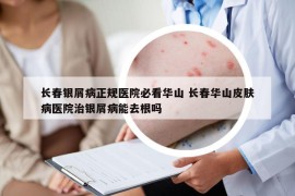 長(zhǎng)春銀屑病正規(guī)醫(yī)院必看華山 長(zhǎng)春華山皮膚病醫(yī)院治銀屑病能去根嗎
