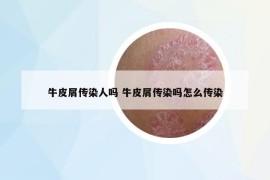 牛皮屑傳染人嗎 牛皮屑傳染嗎怎么傳染