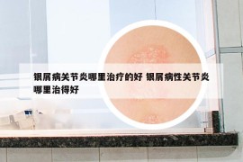 銀屑病關(guān)節(jié)炎哪里治療的好 銀屑病性關(guān)節(jié)炎哪里治得好