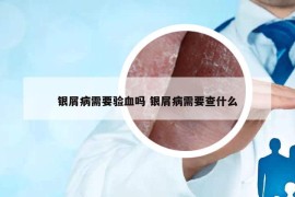 銀屑病需要驗血嗎 銀屑病需要查什么