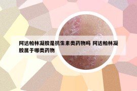 阿達帕林凝膠是抗生素類藥物嗎 阿達帕林凝膠屬于哪類藥物