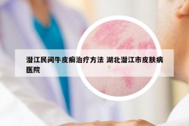 潛江民間牛皮癬治療方法 湖北潛江市皮膚病醫(yī)院