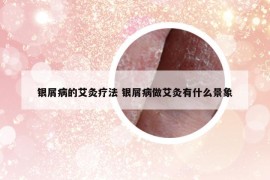 銀屑病的艾灸療法 銀屑病做艾灸有什么景象