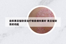 自擬黑豆餾軟膏治療銀屑病效果好 黑豆餾軟膏的功能