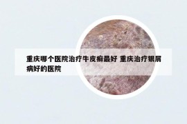 重慶哪個醫(yī)院治療牛皮癬最好 重慶治療銀屑病好的醫(yī)院