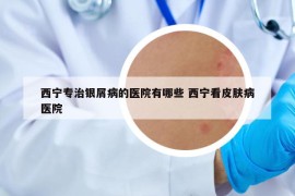 西寧專治銀屑病的醫(yī)院有哪些 西寧看皮膚病醫(yī)院