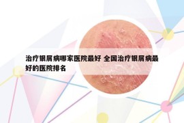 治療銀屑病哪家醫(yī)院最好 全國治療銀屑病最好的醫(yī)院排名