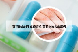 菊花泡水對牛皮癬好嗎 菊花水治頭皮屑嗎