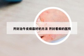 開封治牛皮癬最好的方法 開封看癬的醫(yī)院