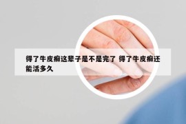 得了牛皮癬這輩子是不是完了 得了牛皮癬還能活多久