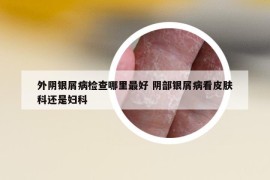 外陰銀屑病檢查哪里最好 陰部銀屑病看皮膚科還是婦科
