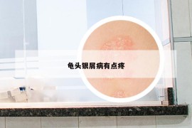 龜頭銀屑病有點(diǎn)疼