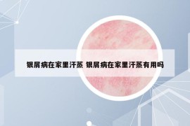 銀屑病在家里汗蒸 銀屑病在家里汗蒸有用嗎