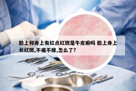 臉上和身上有紅點(diǎn)紅斑是牛皮癬嗎 臉上身上長(zhǎng)紅斑,不痛不癢,怎么了?