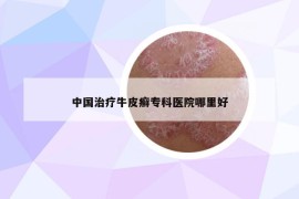 中國治療牛皮癬?？漆t(yī)院哪里好