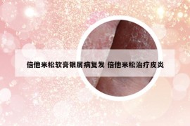 倍他米松軟膏銀屑病復(fù)發(fā) 倍他米松治療皮炎