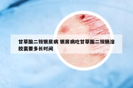 甘草酸二銨銀屑病 銀屑病吃甘草酸二銨腸溶膠囊要多長(zhǎng)時(shí)間