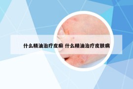什么精油治療皮癬 什么精油治療皮膚病