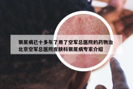 銀屑病已十多年了用了空軍總醫(yī)院的藥物治 北京空軍總醫(yī)院皮膚科銀屑病專家介紹
