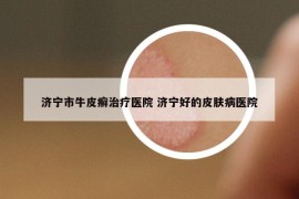 濟(jì)寧市牛皮癬治療醫(yī)院 濟(jì)寧好的皮膚病醫(yī)院