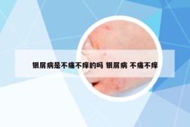 銀屑病是不痛不癢的嗎 銀屑病 不痛不癢