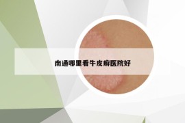 南通哪里看牛皮癬醫(yī)院好