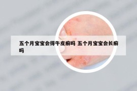 五個(gè)月寶寶會(huì)得牛皮癬嗎 五個(gè)月寶寶會(huì)長癬嗎
