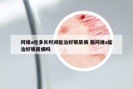 阿維a吃多長(zhǎng)時(shí)間能治好銀屑病 服阿維a能治好銀屑病嗎