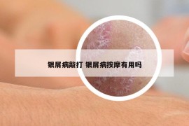 銀屑病敲打 銀屑病按摩有用嗎
