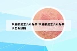 銀屑病是怎么引起的 銀屑病是怎么引起的,該怎么預(yù)防
