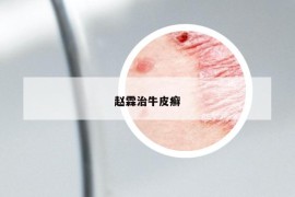趙霖治牛皮癬