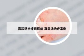 真武湯治療銀屑病 真武湯治療案例