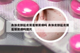 身體皮膚起皮屑是銀屑病嗎 身體皮膚起皮屑是銀屑病嗎圖片