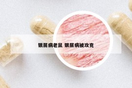 銀屑病老鼠 銀屑病被攻克