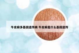 牛皮癬多基因遺傳病 牛皮癬是什么基因遺傳